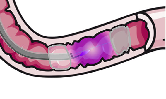 device for cold plasma treatment close