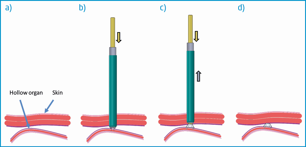 implantation steps Endoges